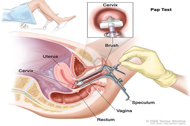 Pap smear cervical screening